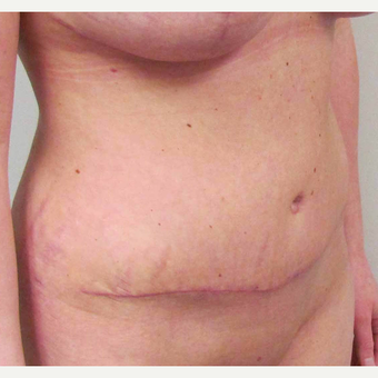 Tummy Tuck for this 31 Year Old Woman after 3092490