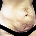 Abdominoplasty (Tummy Tuck) before 980763