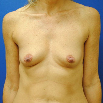 35-44 year old woman treated with Breast Augmentation before 3299808