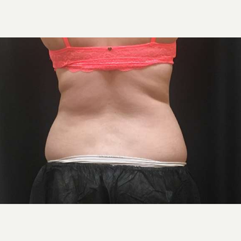 18-24 year old woman treated with CoolSculpting after 3747847