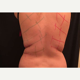 18-24 year old woman treated with CoolSculpting before 3747847