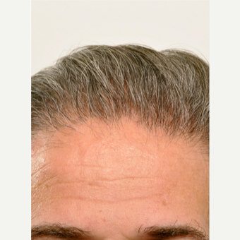 55 year old man treated with Hair Transplant after 3615610