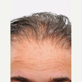 55 year old man treated with Hair Transplant before 3615610
