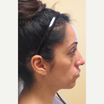35-44 year old woman treated with Liquid Facelift (Botox, Restylane & Voluma) before 3197814