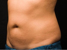 CoolSculpting Procedure with Zeltiq Machine after 218797