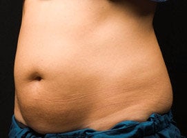 CoolSculpting Procedure with Zeltiq Machine before 218797