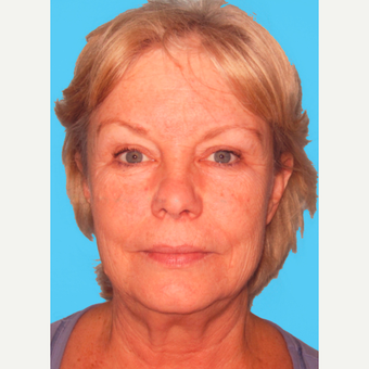 Facelift before 3824897