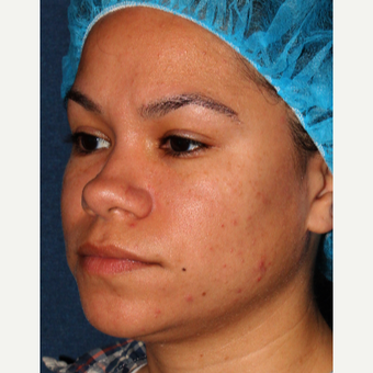 18-24 year old woman treated with Laser Treatment before 3137118