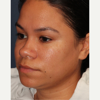18-24 year old woman treated with Laser Treatment after 3137118