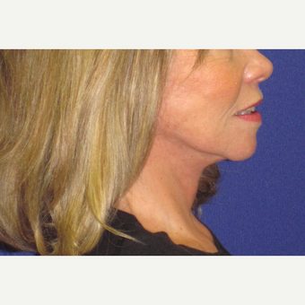 Facelift after 3084928