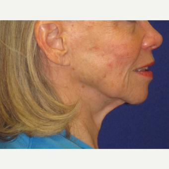 Facelift before 3084928