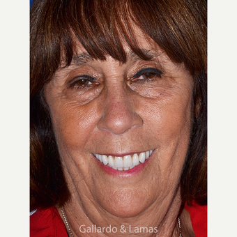 55-64 year old woman treated with All-on-4 Dental Implants after 3265878