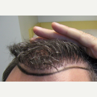 35-44 year old man Hair Transplant Revision. Naturalizing the "old plugs" look before 3175550