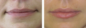 Juvederm for Fuller, Plump Lips before 987769