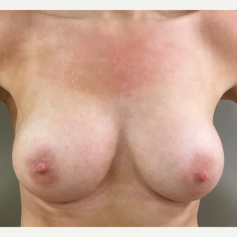 25-34 year old woman treated with Breast Augmentation after 3142624