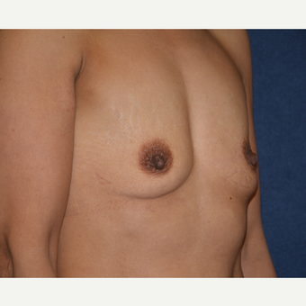 45-54 year old woman treated with Breast Augmentation before 3454901