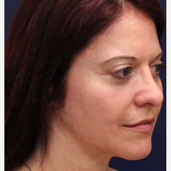 35-44 year old woman treated with Bellafill after 3142695