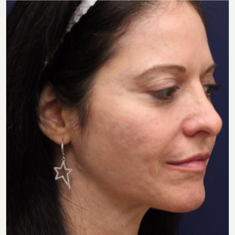 35-44 year old woman treated with Bellafill before 3142695
