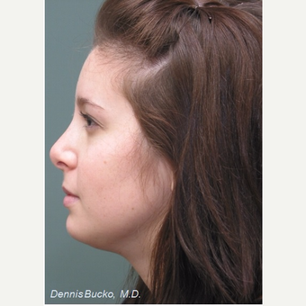 18-24 year old woman treated with Chin Implant after 3523463