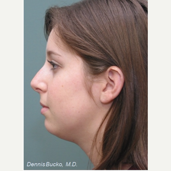 18-24 year old woman treated with Chin Implant before 3523463