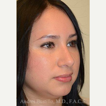 27 year old woman treated with Rhinoplasty after 3460916