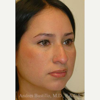 27 year old woman treated with Rhinoplasty before 3460916