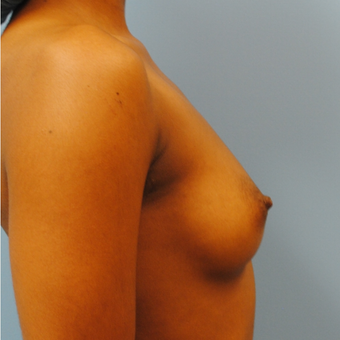 22 year old woman treated with Breast Implants, A to D cup, left 430 cc and right 400 cc ultra high before 3623955