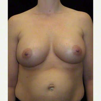34 year old woman treated with Breast Augmentation after 3103653