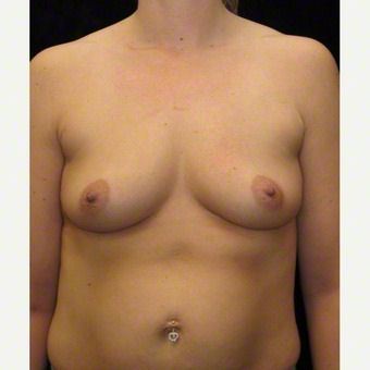 34 year old woman treated with Breast Augmentation before 3103653