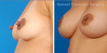Nipple reduction and reshaping before 902704