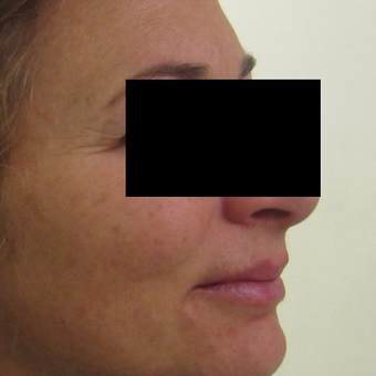 45-54 year old woman treated with Fraxel Laser before 3025463