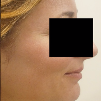 45-54 year old woman treated with Fraxel Laser after 3025463