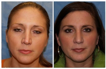 Revision Rhinoplasty before 1129895