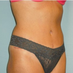 25-34 year old woman treated with Tummy Tuck after 3722302