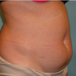 25-34 year old woman treated with Tummy Tuck before 3722302