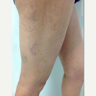 Sclerotherapy before 3164783