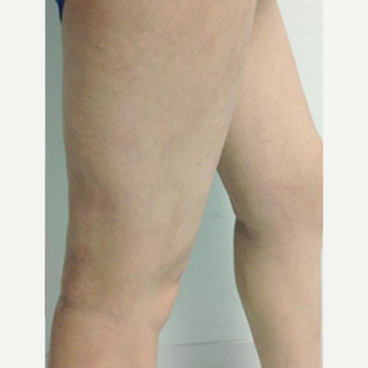 Sclerotherapy after 3164783