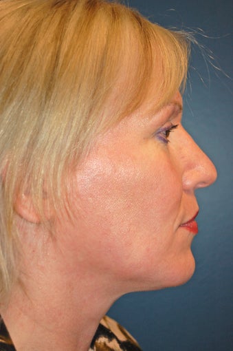 Nose Surgery after 925807