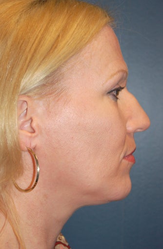 Nose Surgery before 925807