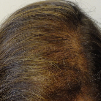 35-44 year old woman treated with PRP for Hair Loss after 2803068