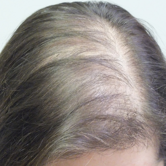 35-44 year old woman treated with PRP for Hair Loss before 2803068