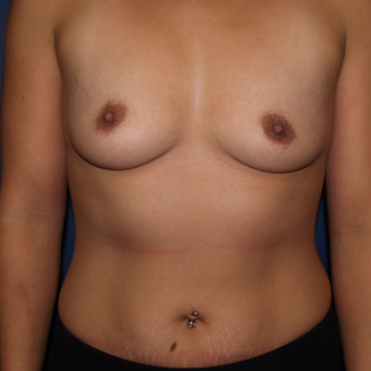 25-34 year old woman treated with Breast Augmentation before 3439569