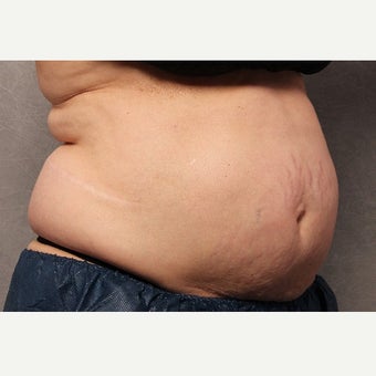 55-64 year old woman treated with CoolSculpting before 2003885