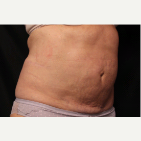 55-64 year old woman treated with CoolSculpting after 2003885