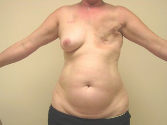 Breast Reconstruction after mastectomy before 1103470