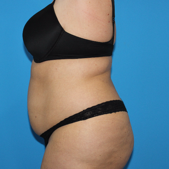35-44 year old woman treated with Smart Lipo before 3332892