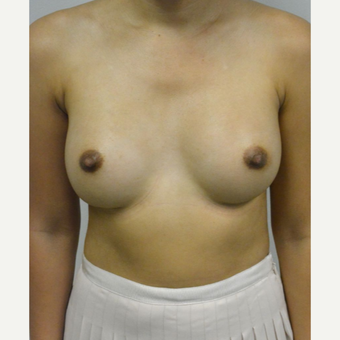 35-44 year old woman treated with Breast Augmentation after 3005046