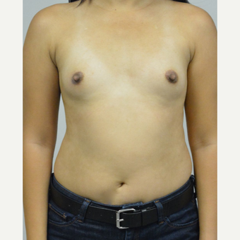 35-44 year old woman treated with Breast Augmentation before 3005046