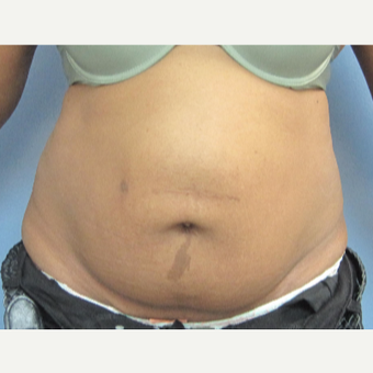 35-44 year old woman treated with Tummy Tuck before 3459640