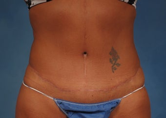 53 year old Female who underwent Tummy Tuck Revision to improve appearance of prior surgery after 1194112